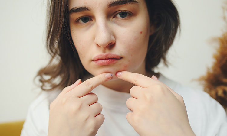 Cómo eliminar el acné en adolescentes