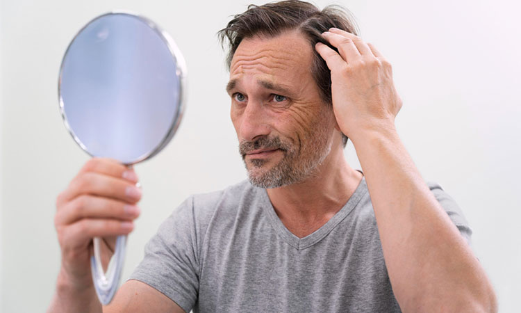 Fraudes con remedios milagrosos contra la calvicie, abundan en las redes