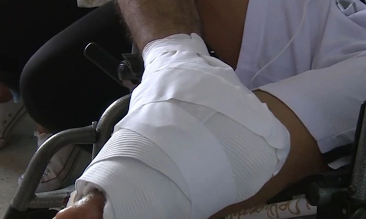 Aumentan los quemados por pólvora en el Valle